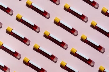 Health: Hypothyroidism: GettyImages-1222976227