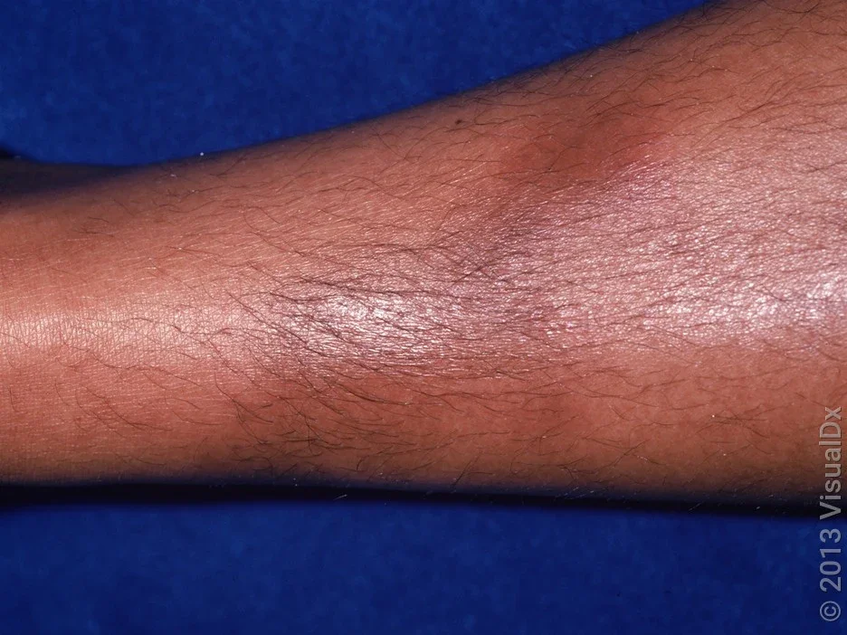 Close-up of erythema nodosum on the shin. 