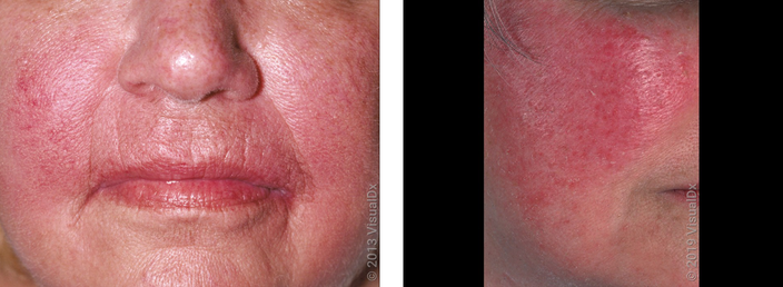 Left: Close-up of redness on cheeks with some small blood vessels visible. Right: Close-up of a cheek with a bright red rash (rosacea).