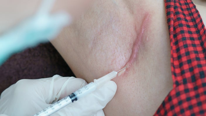 Treatment being injected into a keloid on an armpit.