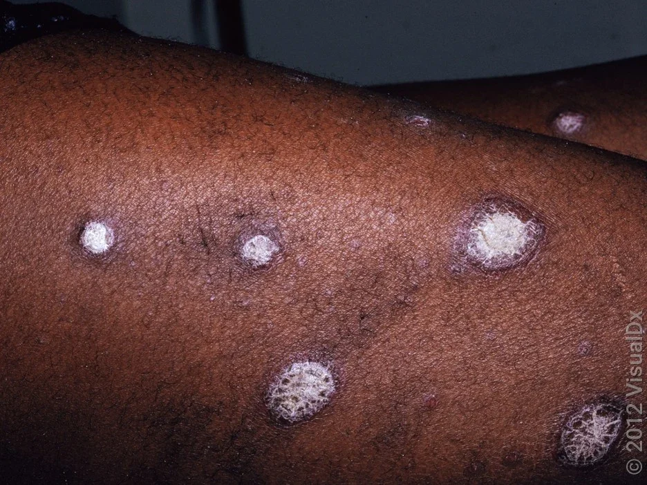 Psoriasis on the leg of a person with darker skin tone.
