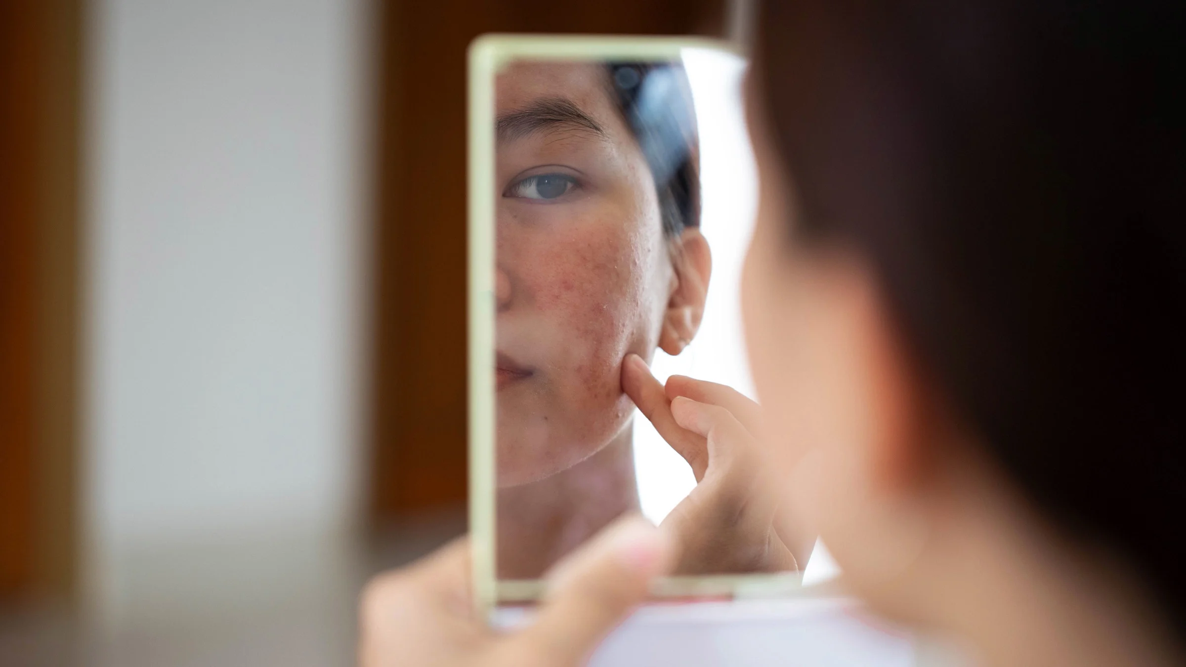 A person with acne looking in a small handheld mirror.