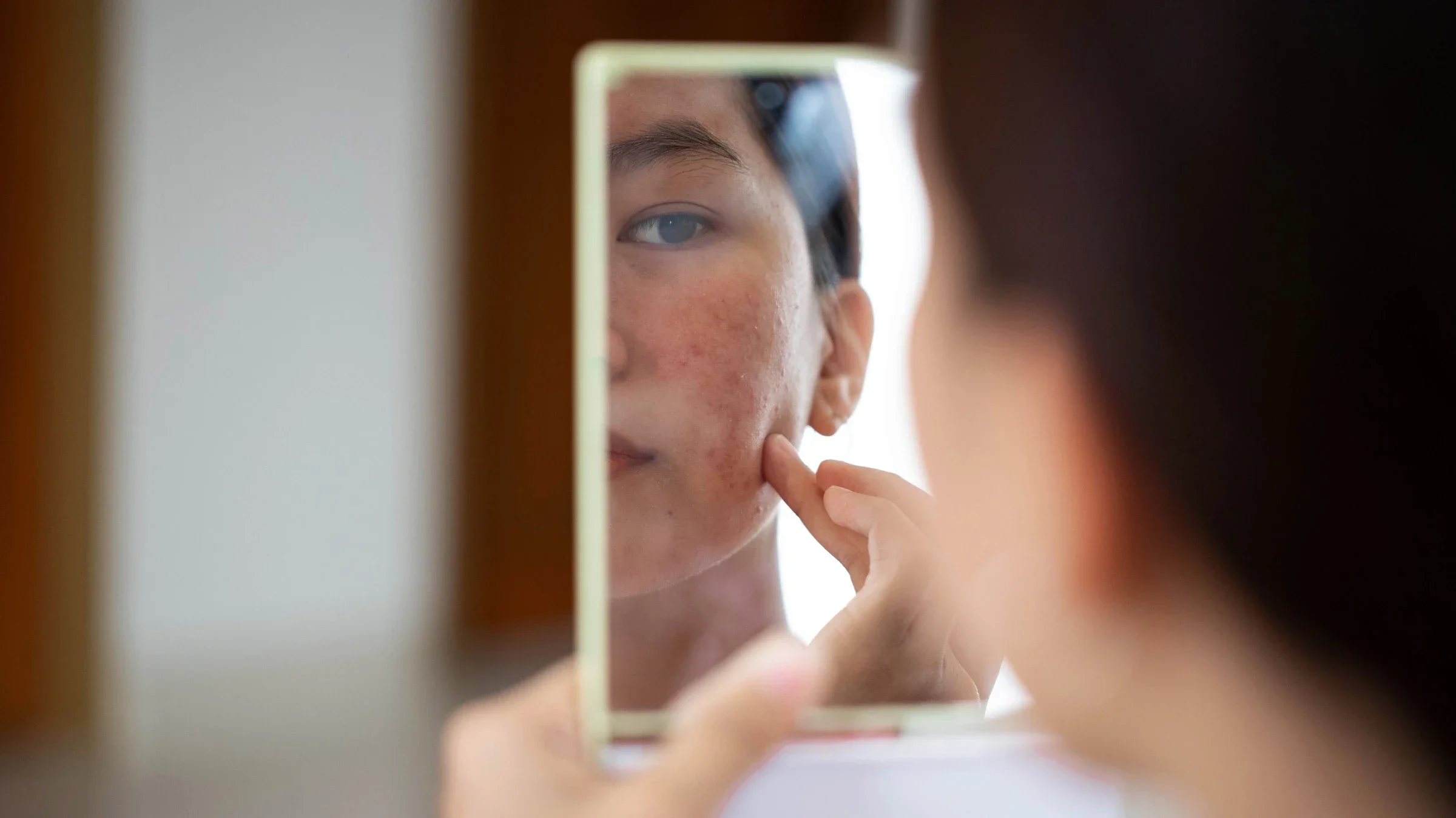 A person with acne looking in a small handheld mirror.
Arisara_Tongdonnoi/iStock via Getty Images Plus  