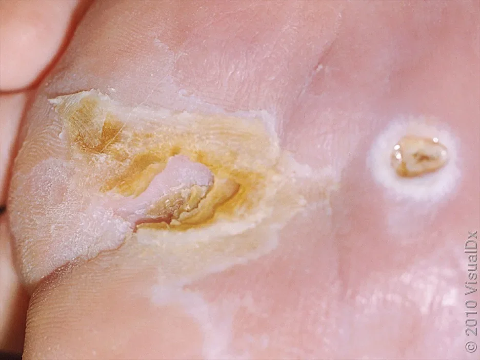 A close-up look at the beginning stage of a diabetic ulcer and a full ulcer on the foot. 
