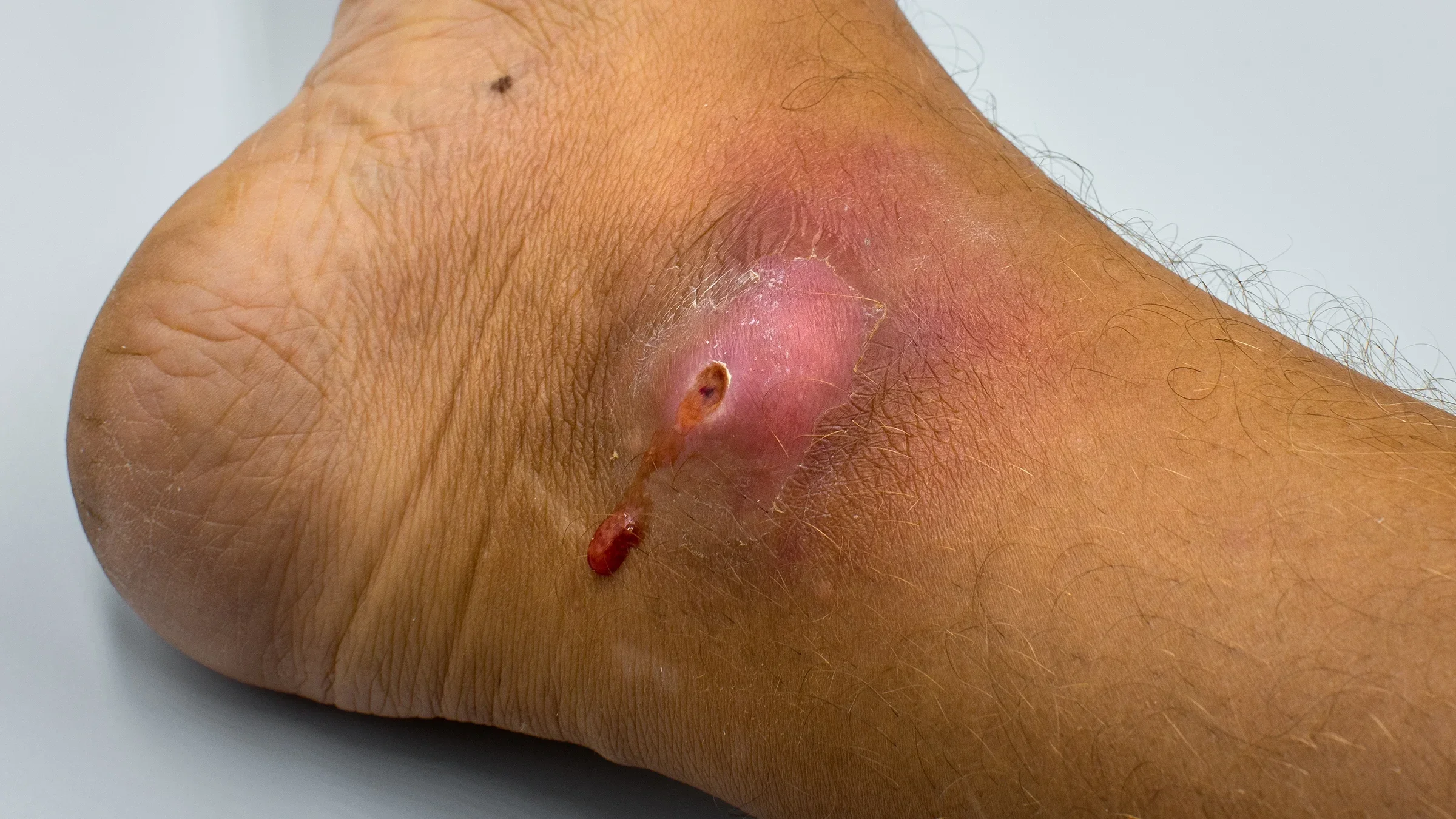 A close-up image shows an ankle wound that could be infected.
Daria Kulkova/iStock via Getty Images
