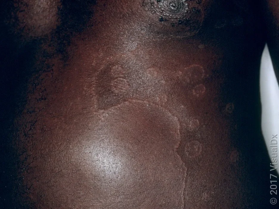 Psoriasis on the abdomen.