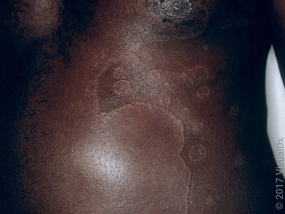 Psoriasis on the abdomen. 