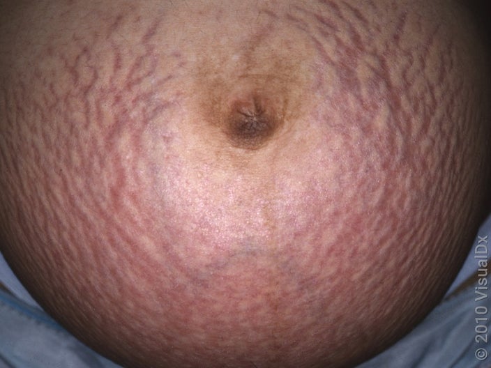 Close-up of striae gravidarum (stretch marks on stomach). 