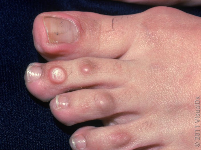 A corn over joint of the second toe.