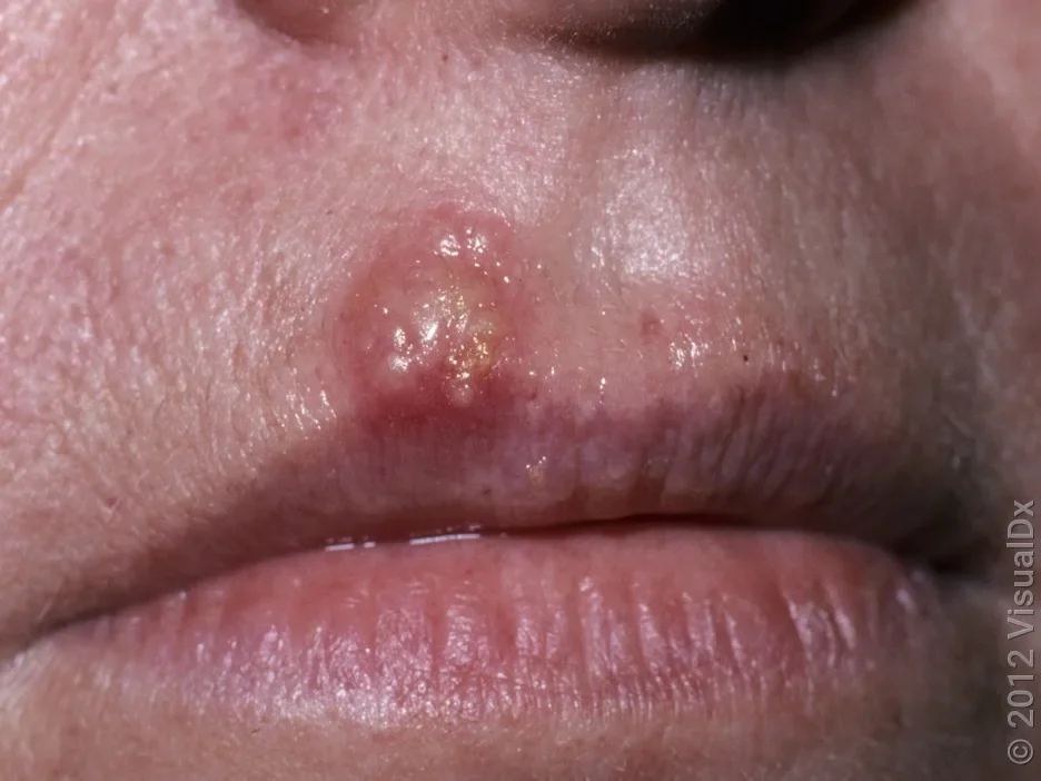 Close-up of blisters on the upper lip.