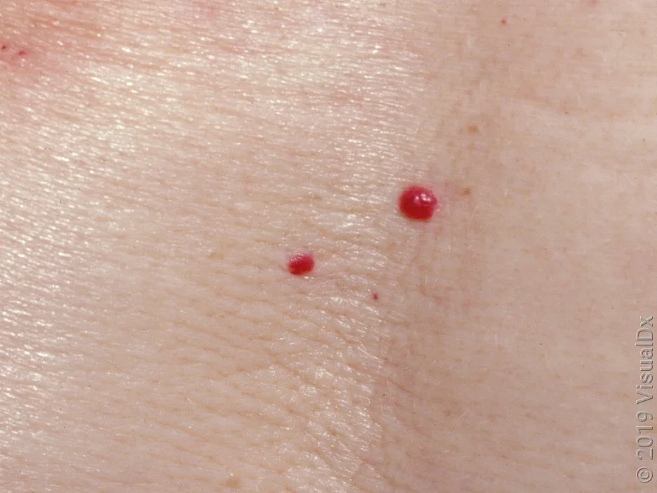 Close-up of cherry angiomas (red freckles).