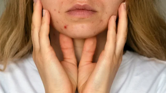 Dermatology: closeup acne on face 1432309651