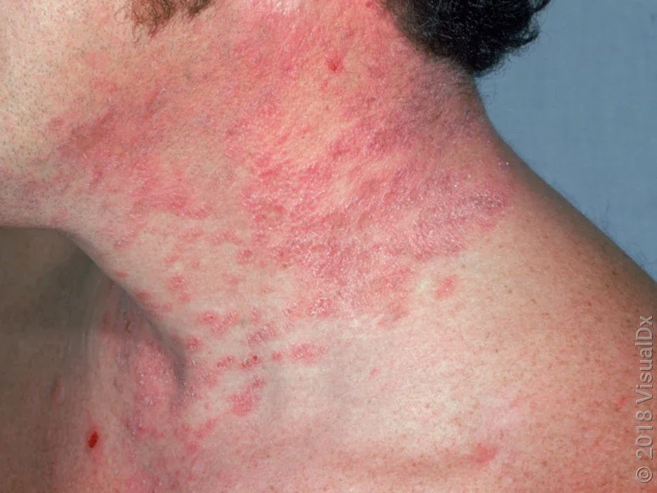 Close-up of many red bumps on the neck from a sun allergy.