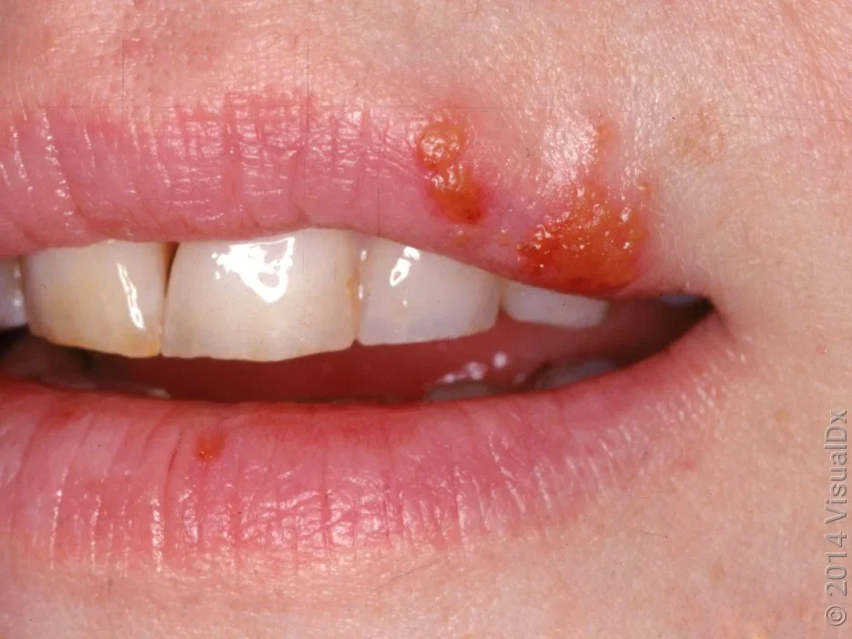 Close-up of a cold sore crusting over.