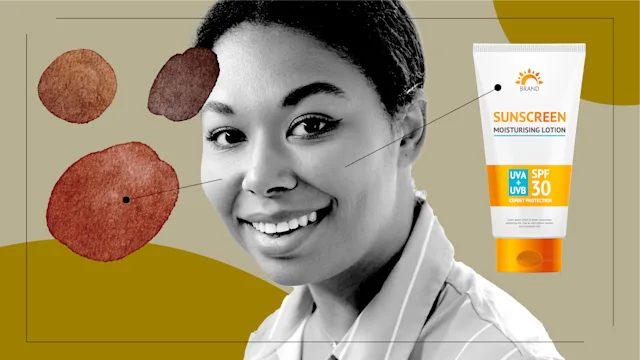 What Is It Like to Use Hydroquinone Skin-Bleaching Cream for Dark Spots?