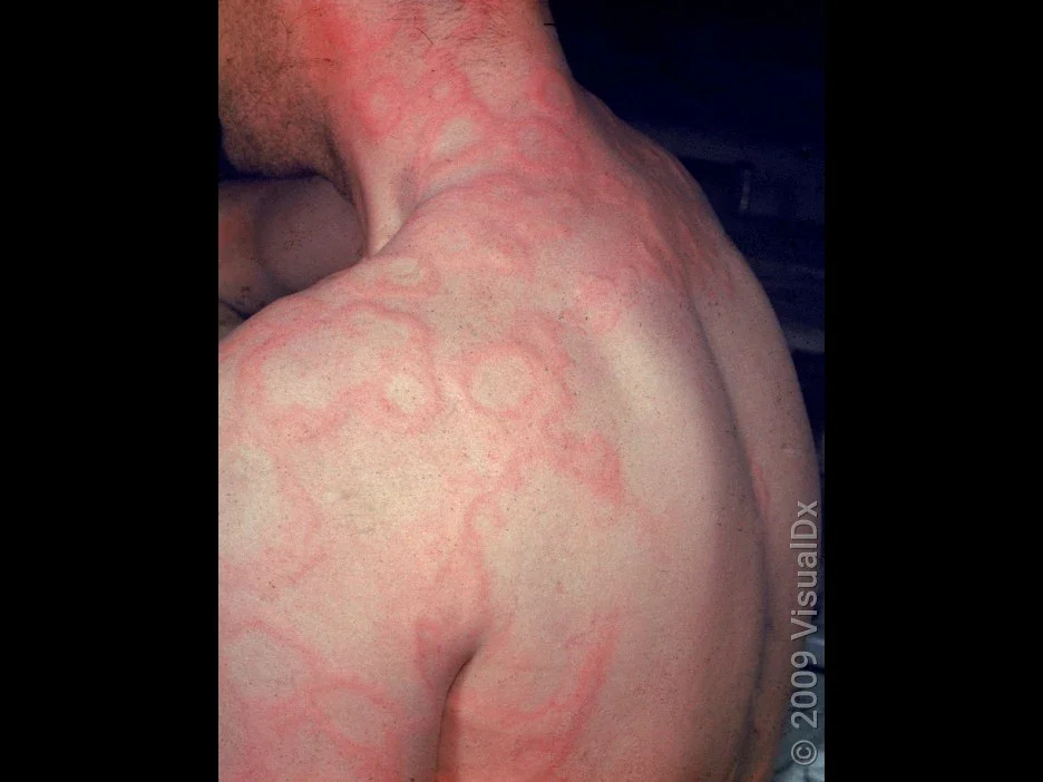 Large welts (hives) on the torso caused by a medication like an antibiotic.