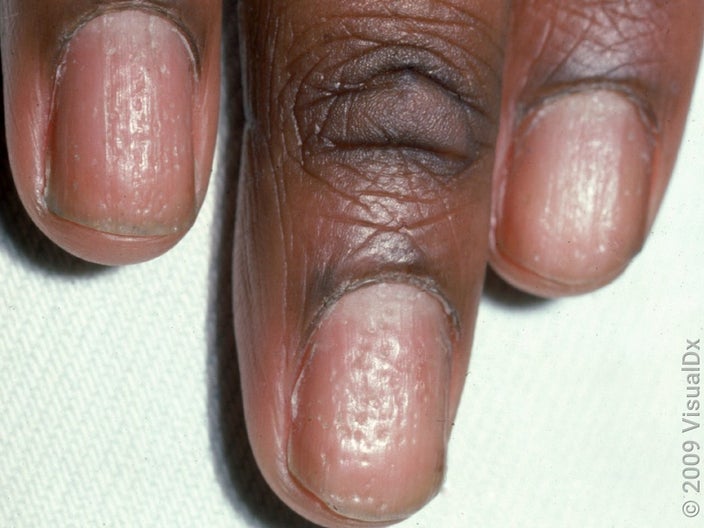 Close-up of nails covered in tiny dents (psoriasis nail pitting). 