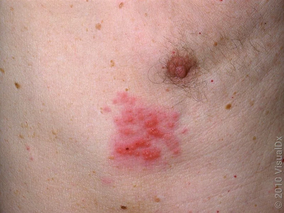 Close-up of a shingles rash on the chest. 