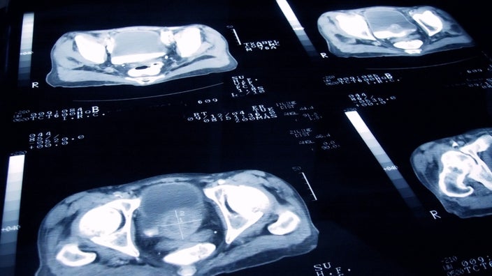Prostate scan slides on a light board.