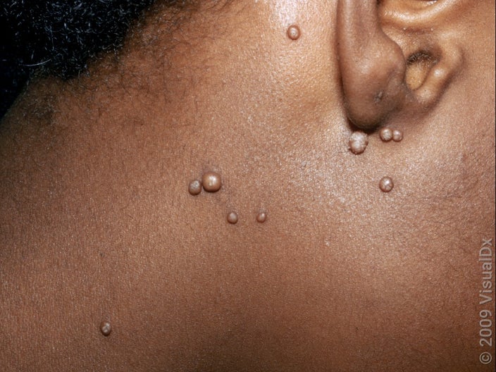 More advanced molluscum are larger and can have a central dimple. 