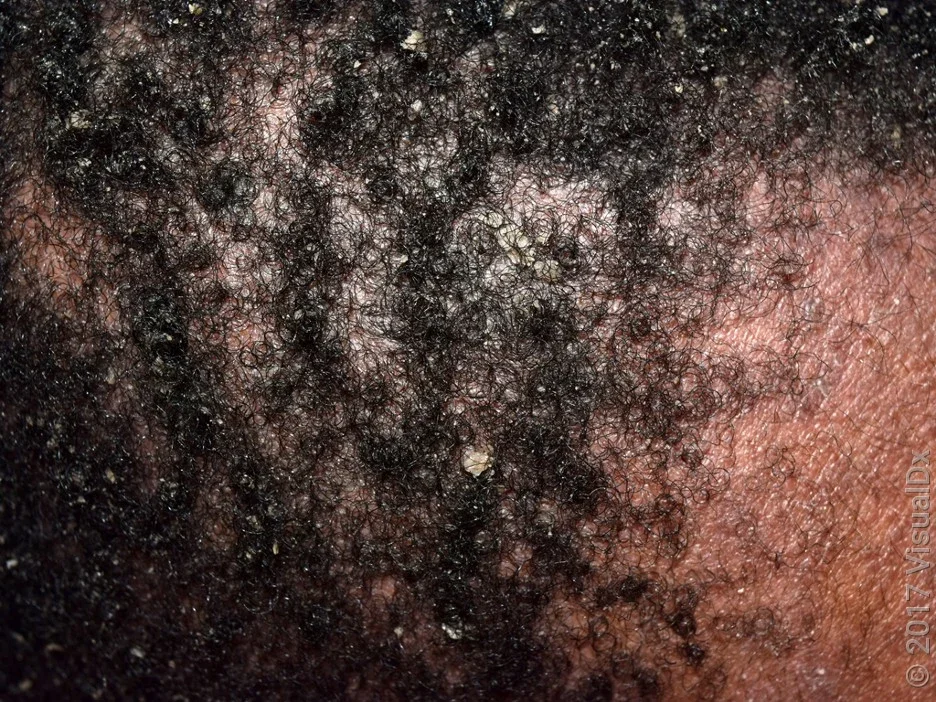 Close-up of scalp with thick, yellow flakes from dandruff. 