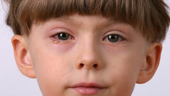 Health: Eye: young boy with pink eye-145996939