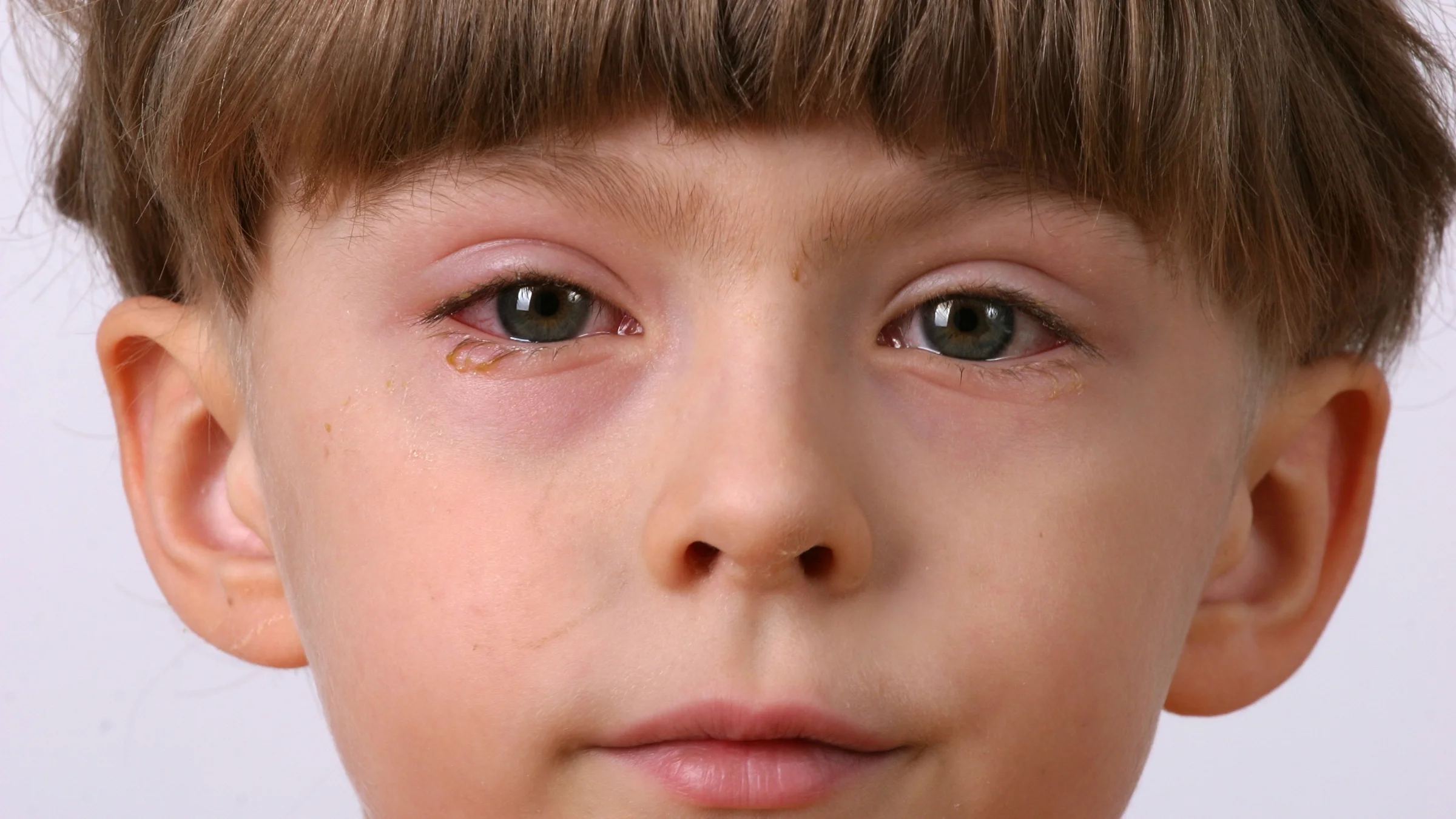 Close-up cropped shot of a young boy in a bowl cut. The focus is on his eyes that have conjunctivitis.