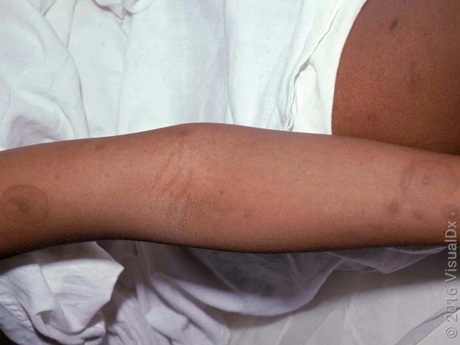 Dark patches caused by post-inflammatory hyperpigmentation from chickenpox. 
