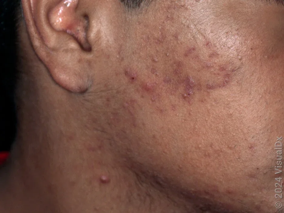 Close-up of inflammatory acne on the cheek.