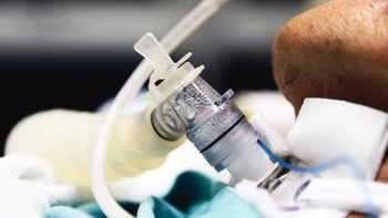 Respiratory: closeup tracheostomy 853238750