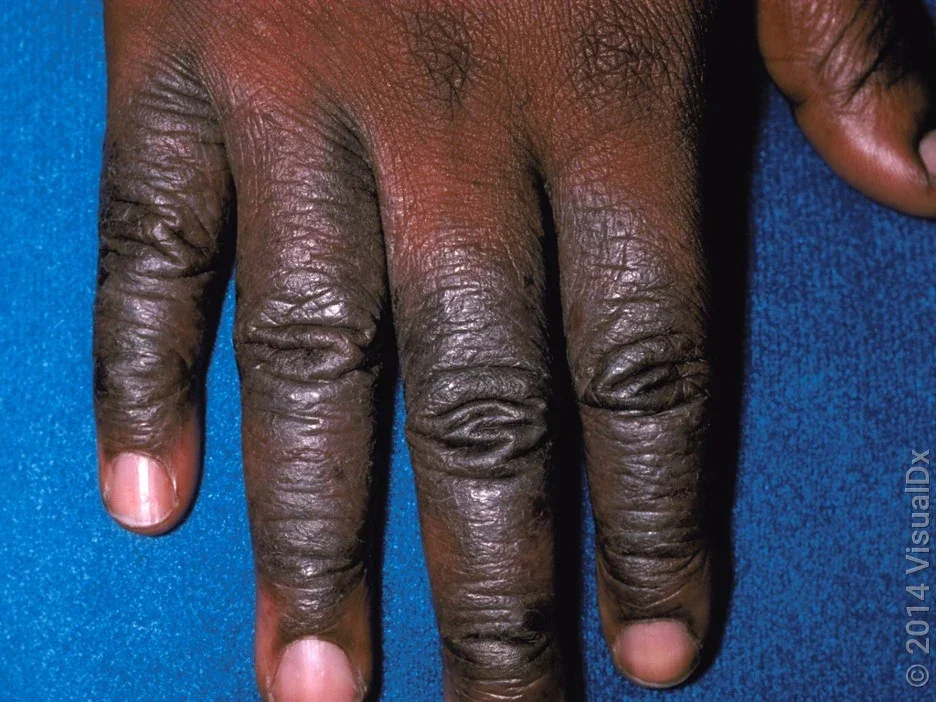 Close-up of eczema on the fingers. 