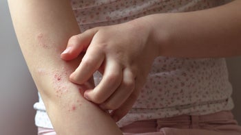 eczema: scratching eczema on arm 1314008576