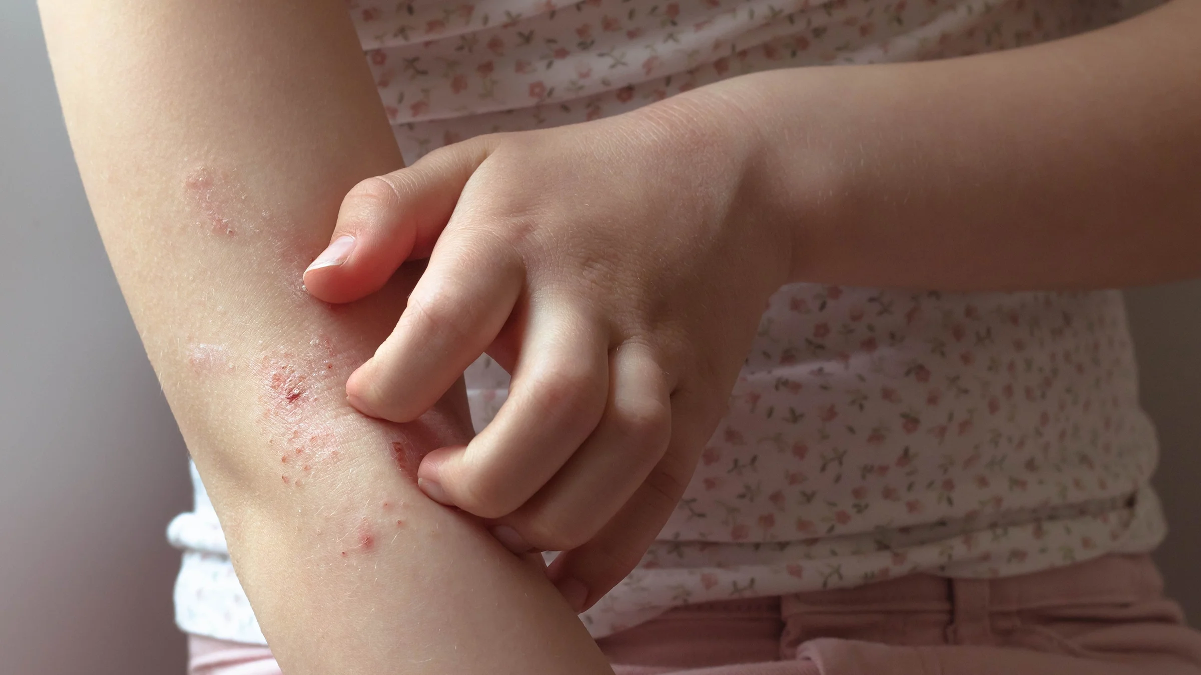 Cropped shot of a young girl scratching her inner elbow. She has eczema and scabs where she is scratching.