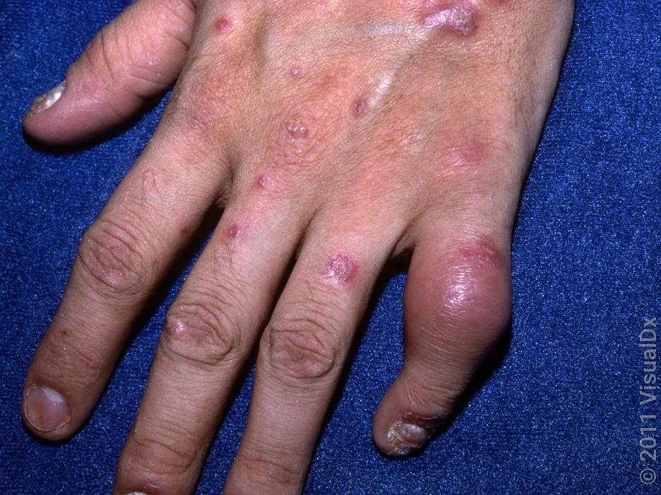 Close-up of a hand with a psoriatic arthritis rash flare and joint swelling.