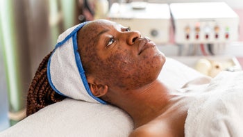 Skin discoloration: women of color: hyperpigmentation treatment 1487810634