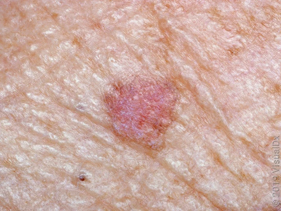 Close-up of an actinic keratosis.