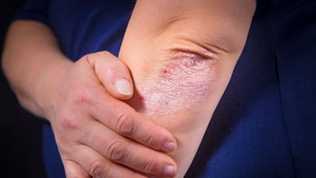 Psoriasis: Dermatology: psoriasis on elbow-510954994