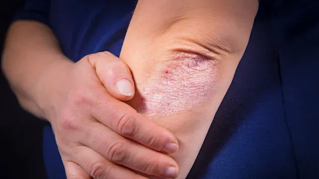 Psoriasis: Dermatology: psoriasis on elbow-510954994