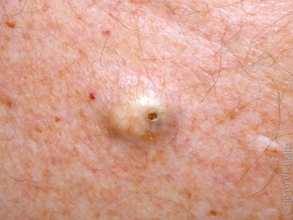 Close-up of a sebaceous cyst with a central opening.