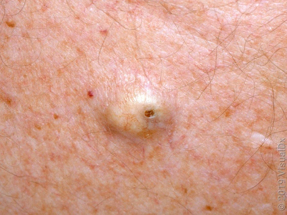 Close-up of a sebaceous cyst with a central opening.