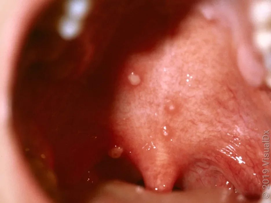 Close-up of chickenpox blisters inside the mouth.