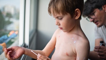 Chickenpox: Dermatology: applying cream on child with chicken pox 1478112648