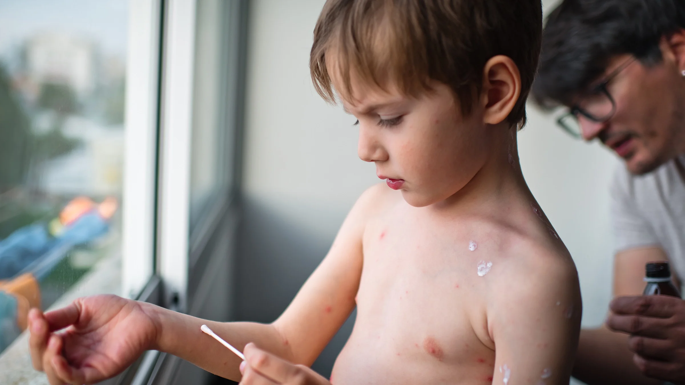 A boy with chickenpox gets cream applied to his rash.