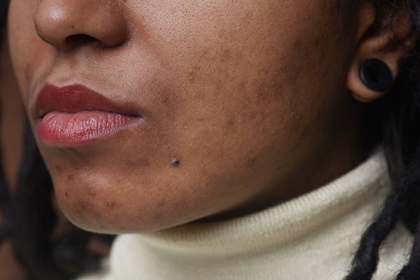 Acne
